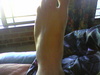 Broken foot - Click To Enlarge Picture